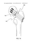 SYSTEM AND METHOD FOR THE FIXATION OF BONE FRACTURES diagram and image