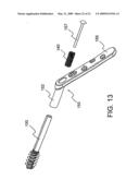 SYSTEM AND METHOD FOR THE FIXATION OF BONE FRACTURES diagram and image