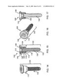 SYSTEM AND METHOD FOR THE FIXATION OF BONE FRACTURES diagram and image