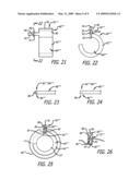 SECUREMENT ASSEMBLY AND METHOD FOR EXPANDABLE ENDOVASCULAR DEVICE diagram and image