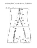 DELIVERY SYSTEM AND METHOD FOR BIFURCATED GRAFT diagram and image