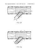 Extendible Stent Apparatus and Method for Deploying the Same diagram and image