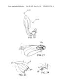 LARYNGEAL MASK AIRWAY DEVICE diagram and image