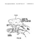 TREATMENT OF PREMATURE BIRTH COMPLICATIONS diagram and image