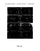 NOVEL NON-SELECTIVE CATION CHANNEL IN NEURONAL CELLS AND METHOD FOR TREATING BRAIN SWELLING diagram and image