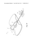 SECUREMENT SYSTEM FOR A MEDICAL ARTICLE diagram and image