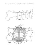 APPARATUS AND METHOD FOR SECURING BONE diagram and image