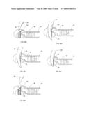 Suture passing instrument and method diagram and image