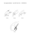 Suture passing instrument and method diagram and image