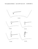 Suture passing instrument and method diagram and image