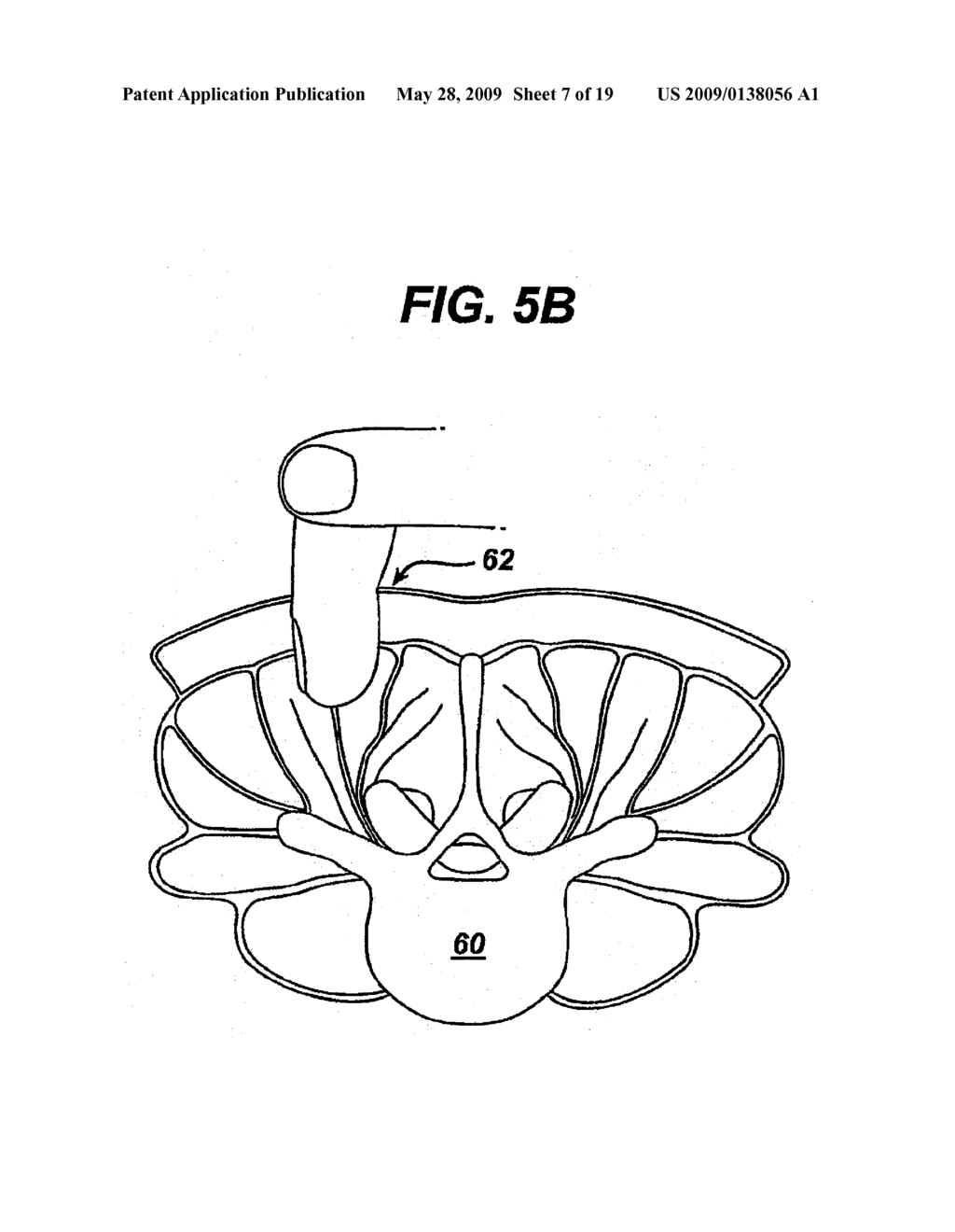 METHODS AND DEVICES FOR MINIMALLY INVASIVE SPINAL FIXATION ELEMENT PLACEMENT - diagram, schematic, and image 08