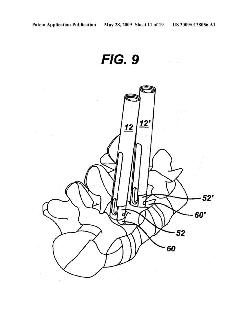 METHODS AND DEVICES FOR MINIMALLY INVASIVE SPINAL FIXATION ELEMENT PLACEMENT - diagram, schematic, and image 12