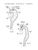 Devices, systems, and methods for endovascular staple and/or prosthesis delivery and implantation diagram and image