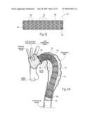 Devices, systems, and methods for endovascular staple and/or prosthesis delivery and implantation diagram and image