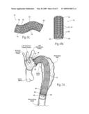 Devices, systems, and methods for endovascular staple and/or prosthesis delivery and implantation diagram and image