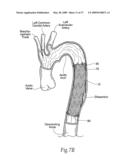 Devices, systems, and methods for endovascular staple and/or prosthesis delivery and implantation diagram and image