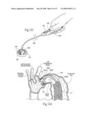 Devices, systems, and methods for endovascular staple and/or prosthesis delivery and implantation diagram and image