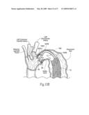 Devices, systems, and methods for endovascular staple and/or prosthesis delivery and implantation diagram and image