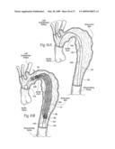 Devices, systems, and methods for endovascular staple and/or prosthesis delivery and implantation diagram and image