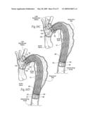 Devices, systems, and methods for endovascular staple and/or prosthesis delivery and implantation diagram and image