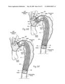 Devices, systems, and methods for endovascular staple and/or prosthesis delivery and implantation diagram and image