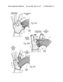 Devices, systems, and methods for endovascular staple and/or prosthesis delivery and implantation diagram and image