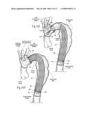 Devices, systems, and methods for endovascular staple and/or prosthesis delivery and implantation diagram and image