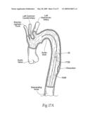 Devices, systems, and methods for endovascular staple and/or prosthesis delivery and implantation diagram and image