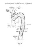 Devices, systems, and methods for endovascular staple and/or prosthesis delivery and implantation diagram and image