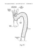 Devices, systems, and methods for endovascular staple and/or prosthesis delivery and implantation diagram and image