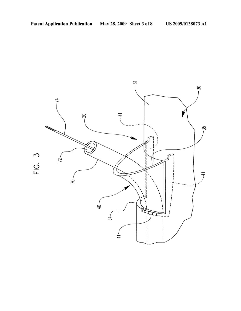 Bifurcation Stent Assembly - diagram, schematic, and image 04