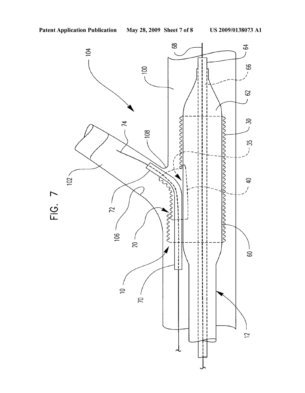 Bifurcation Stent Assembly - diagram, schematic, and image 08