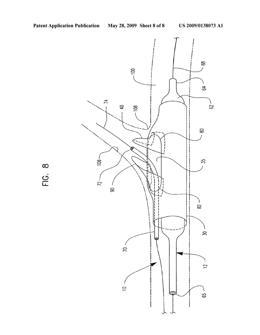 Bifurcation Stent Assembly - diagram, schematic, and image 09