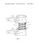 Stackable Intervertebral Devices and Methods of Use diagram and image