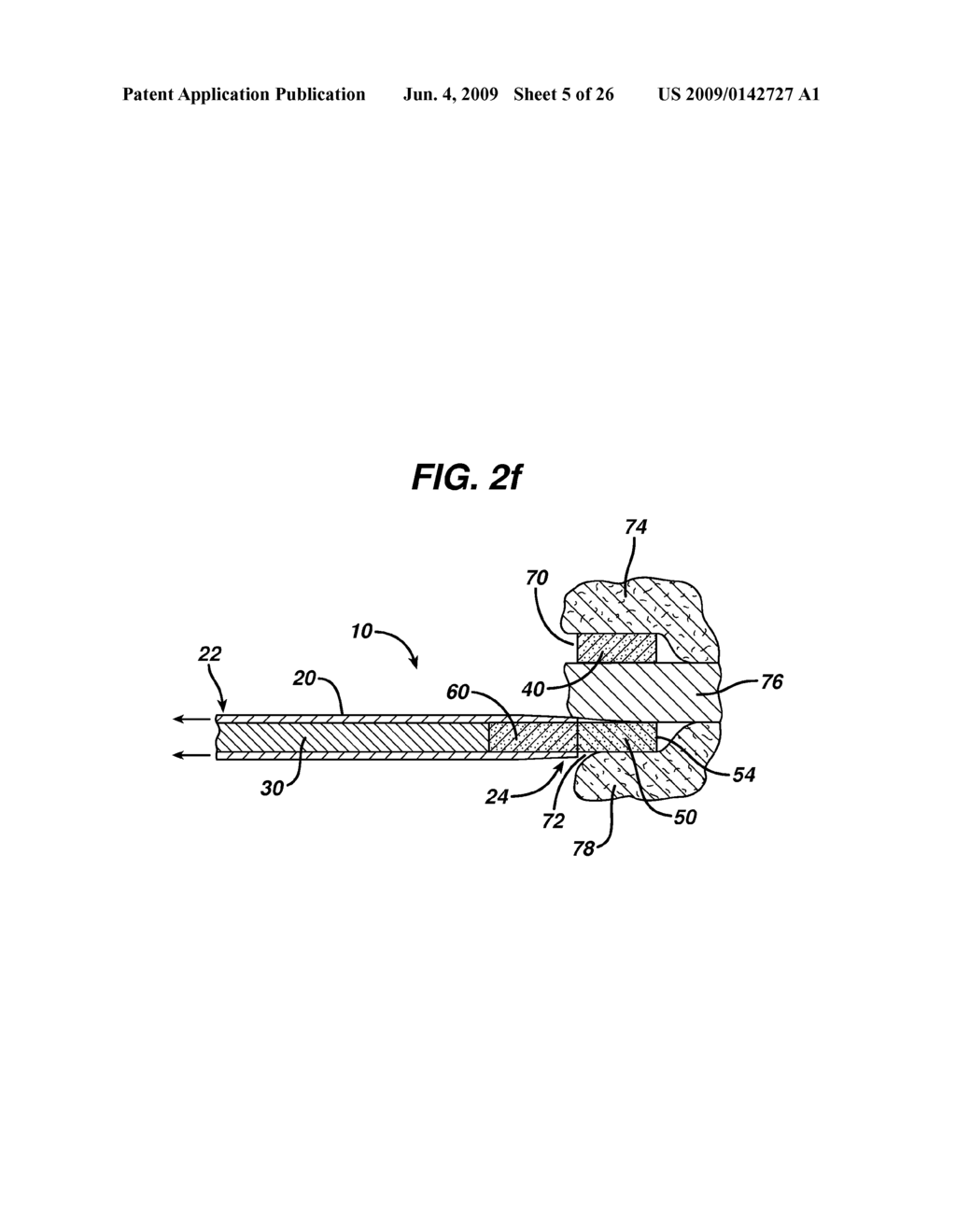 DEVICE FOR DELIVERING MEDICINAL IMPLANTS - diagram, schematic, and image 06