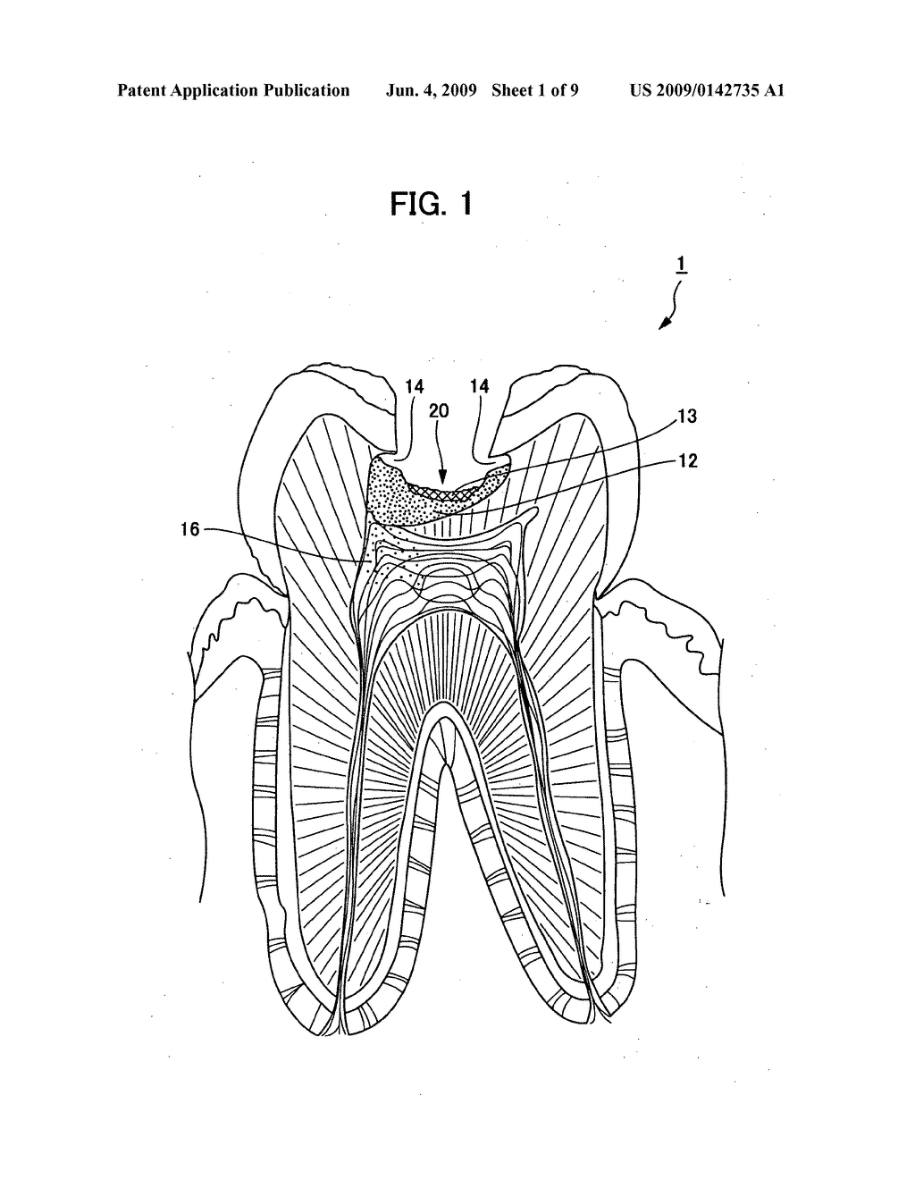 Bacterial intraoral disease treatment composition, washing treatment solution, hemostatic treatment solution, and bacterial intraoral disease treatment method - diagram, schematic, and image 02