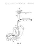 Catheter guided endotracheal intubation diagram and image