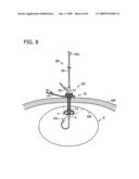 ENDOSCOPE SYSTEM FOR GASTROSTOMY CATHETER PLACEMENT diagram and image