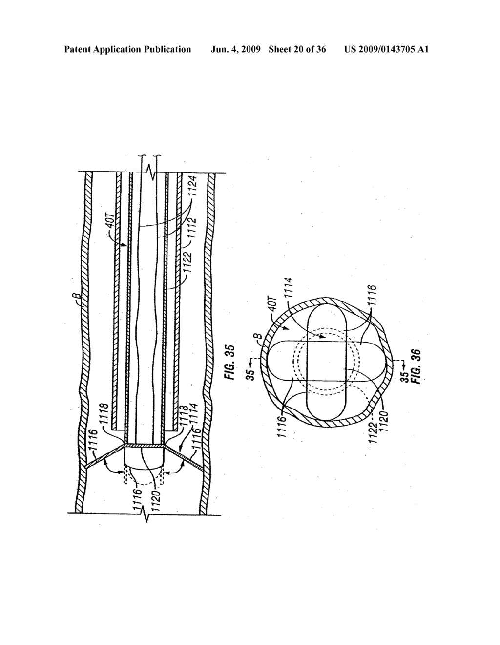 MODIFICATION OF AIRWAYS BY APPLICATION OF ULTRASOUND ENERGY - diagram, schematic, and image 21