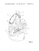 Biliary Shunts, Delivery Systems, Methods of Using the Same and Kits Therefor diagram and image