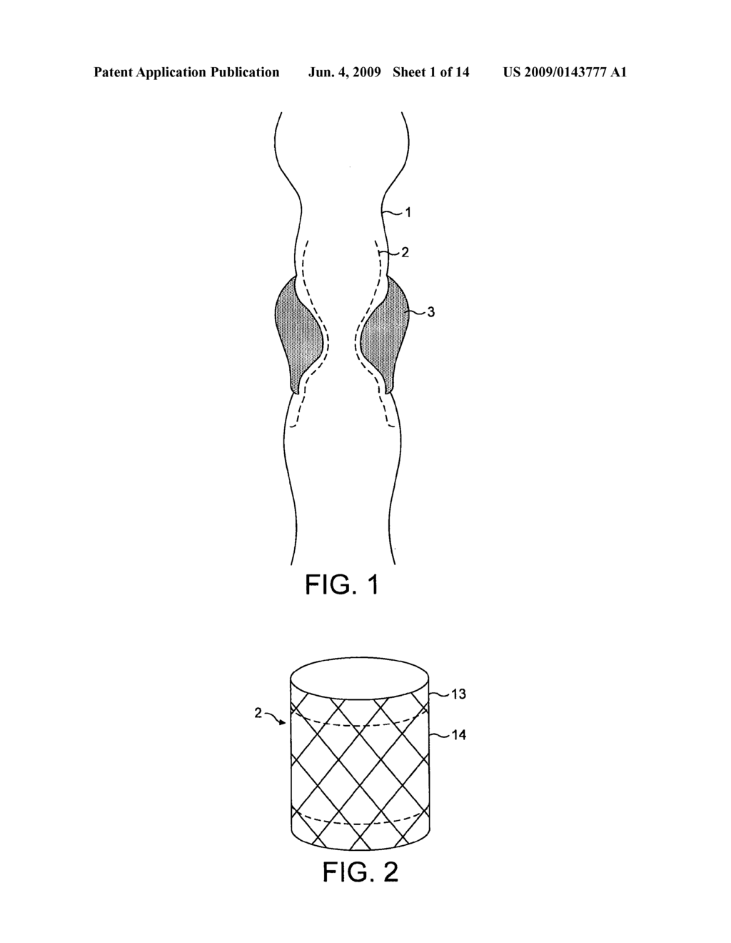 APPARATUS AND METHOD FOR TREATING TISSUE SUCH AS TUMOURS - diagram, schematic, and image 02
