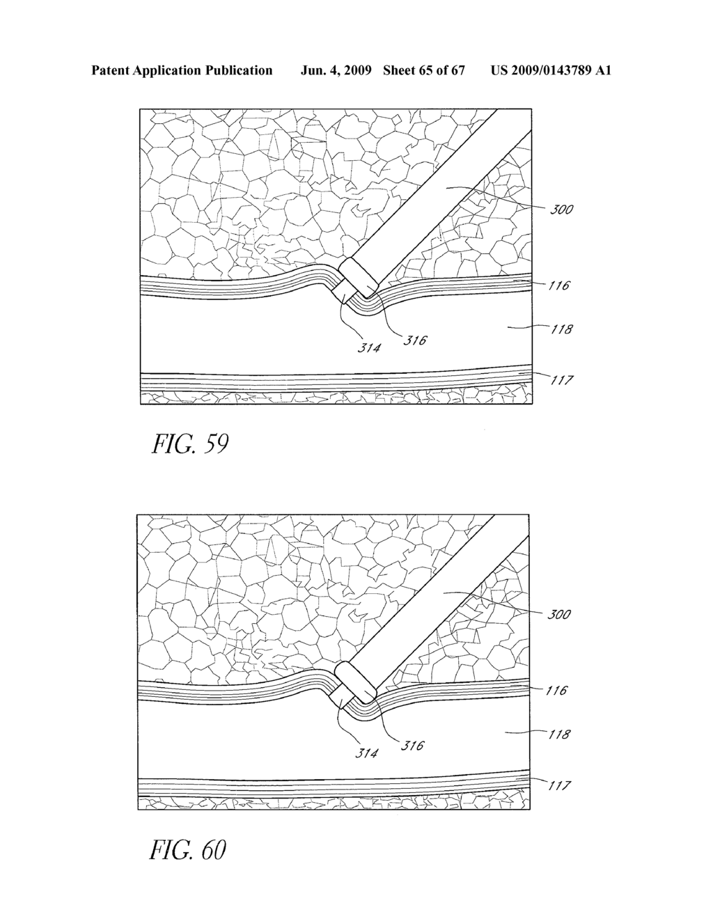 VASCULAR CLOSURE DEVICES, SYSTEMS, AND METHODS OF USE - diagram, schematic, and image 66