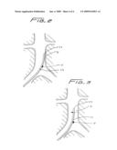 Method of inserting a vein filter diagram and image