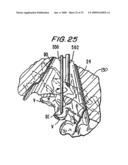 ACCESS DEVICE FOR MINIMALLY INVASIVE SURGERY diagram and image