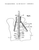 ACCESS DEVICE FOR MINIMALLY INVASIVE SURGERY diagram and image