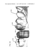 DESIGN OF DENTAL APPLIANCES diagram and image