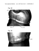 DESIGN OF DENTAL APPLIANCES diagram and image