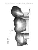 DESIGN OF DENTAL APPLIANCES diagram and image