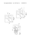 Apparatus and Method for Application of a Pharmaceutical to a Surface of an External Ear Canal for Treatment of Keratosis Obutrans diagram and image