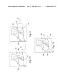 Apparatus and Method for Application of a Pharmaceutical to a Surface of an External Ear Canal for Treatment of Keratosis Obutrans diagram and image